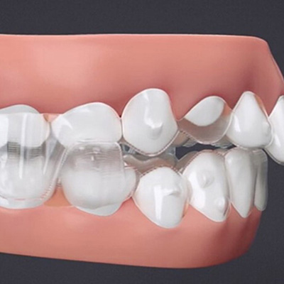 La estabilizacin mandibular y la precisin articulatoria