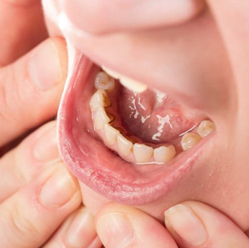 Los problemas dentales afectan el lenguaje?