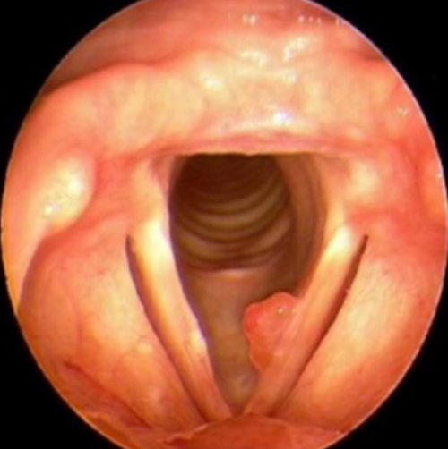 Nódulos  y pólipos en las cuerdas vocales