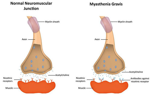 Miastenia gravis (MG)