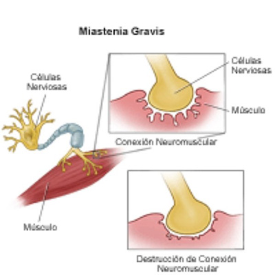 Miastenia gravis (MG)