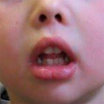 Síndrome de respirador bucal. Generalidades