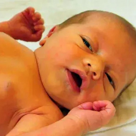 La importancia de reconocer la ictericia en los reci�n nacidos: un llamado a la prevenci�n