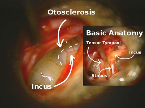 Otosclerosis